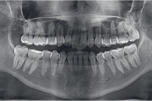 歯科用CTでの三次元解析