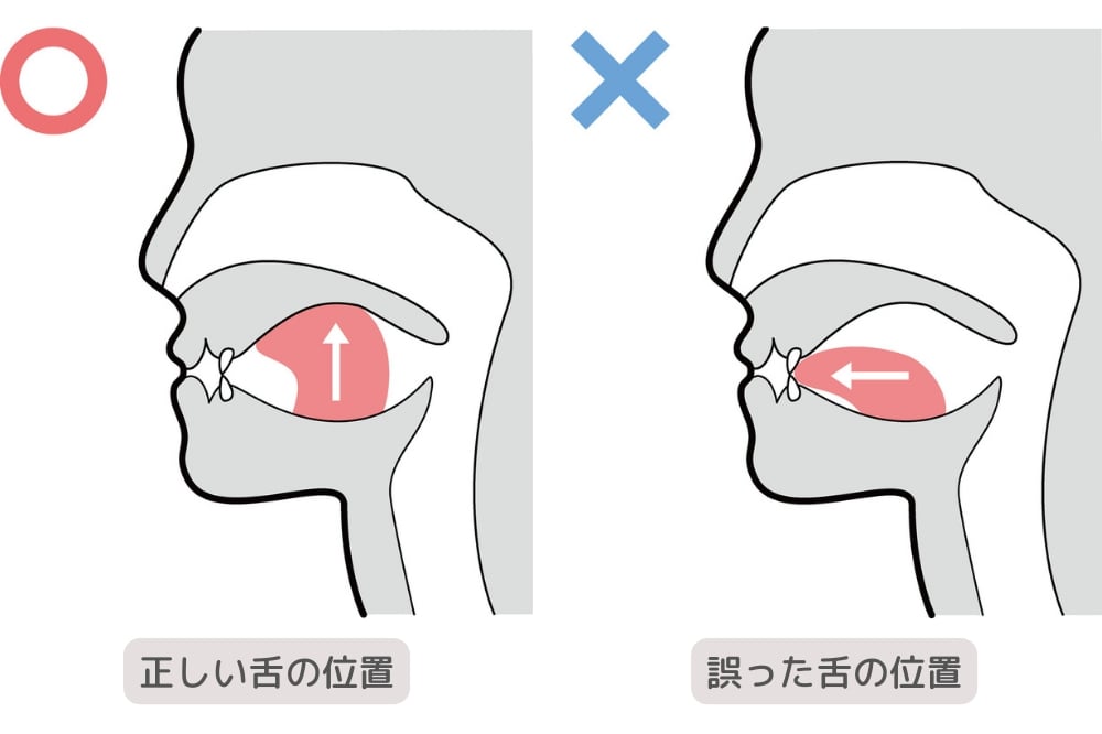 正しい舌の位置と誤った舌の位置