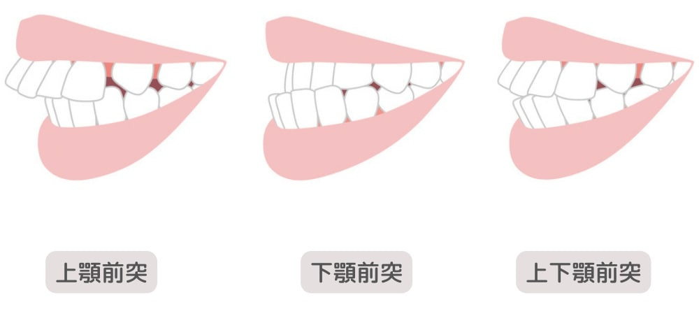 上顎前突と下顎前突と上下顎前突