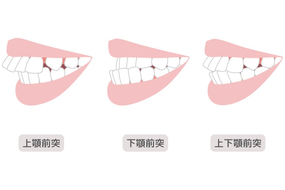 上顎前突と下顎前突と上下顎前突