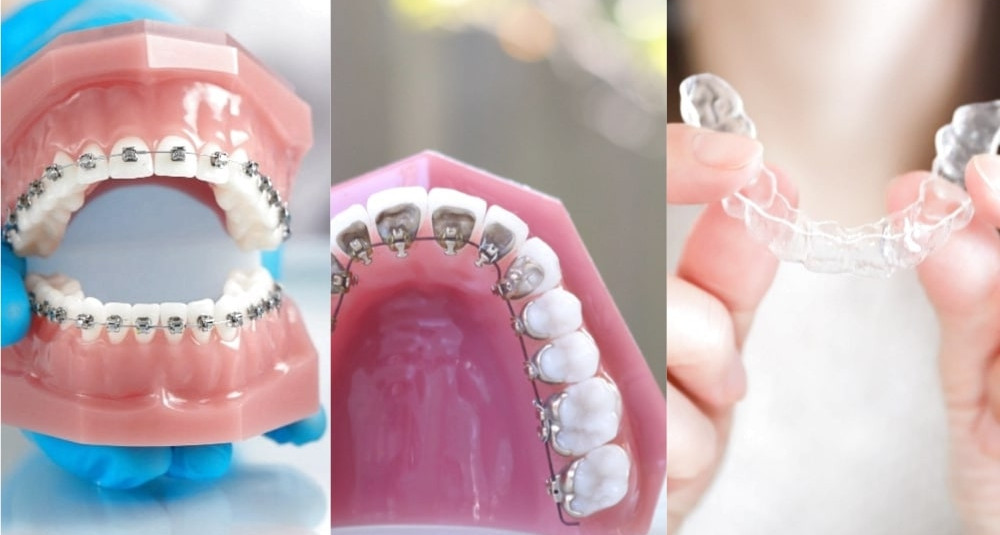 ワイヤー矯正（表側・裏側）とマウスピース矯正