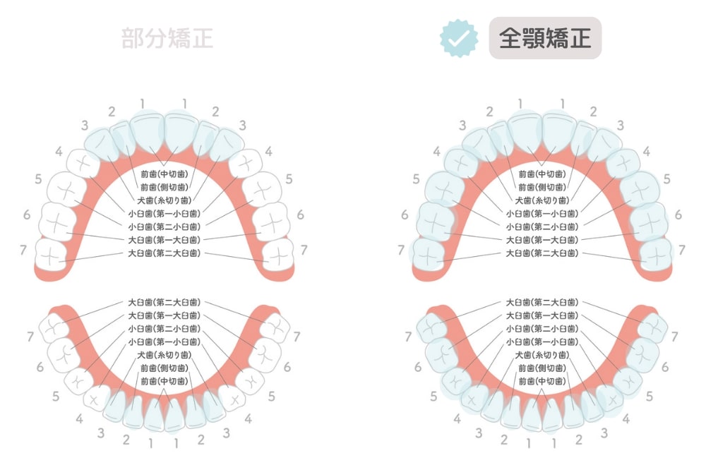 全顎矯正の治療範囲