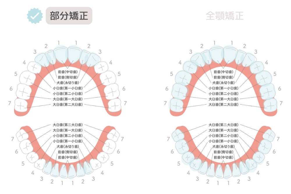 部分矯正の治療範囲