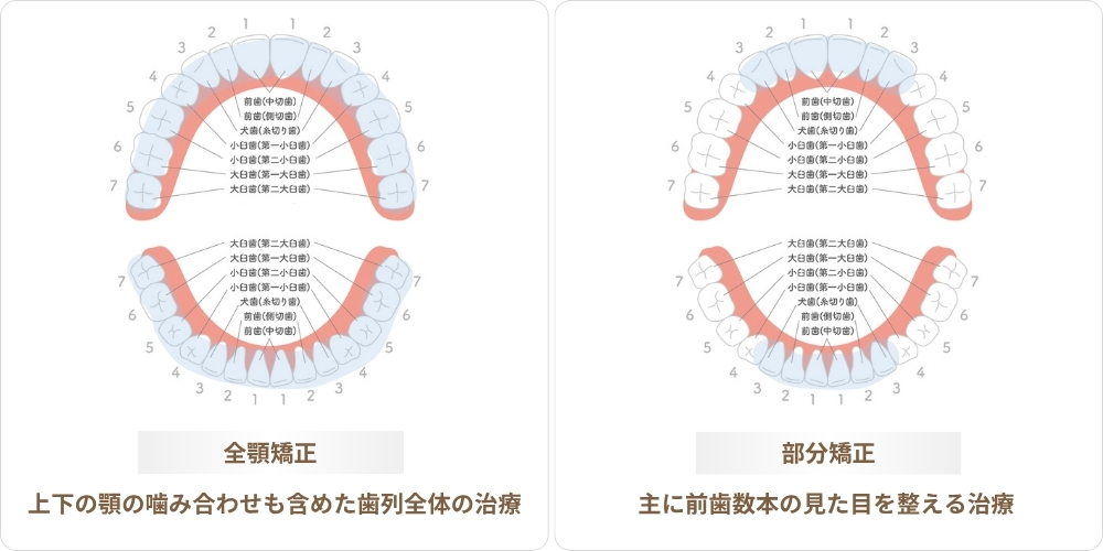 全顎矯正と部分矯正の治療範囲