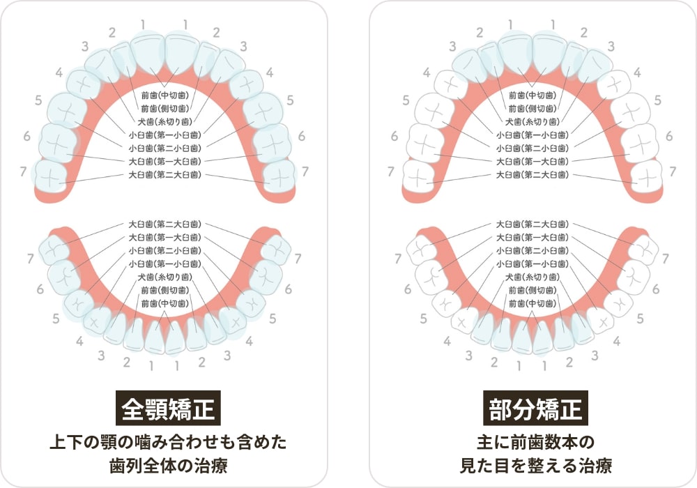 全顎矯正と部分矯正の治療範囲