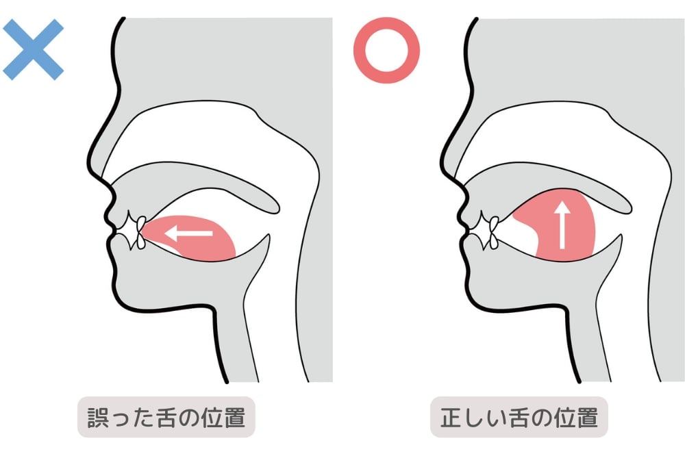 誤った舌の位置と正しい舌の位置