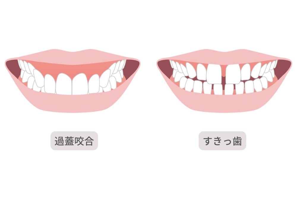 過蓋咬合とすきっ歯