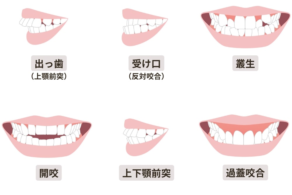 歯列矯正が必要な歯並び