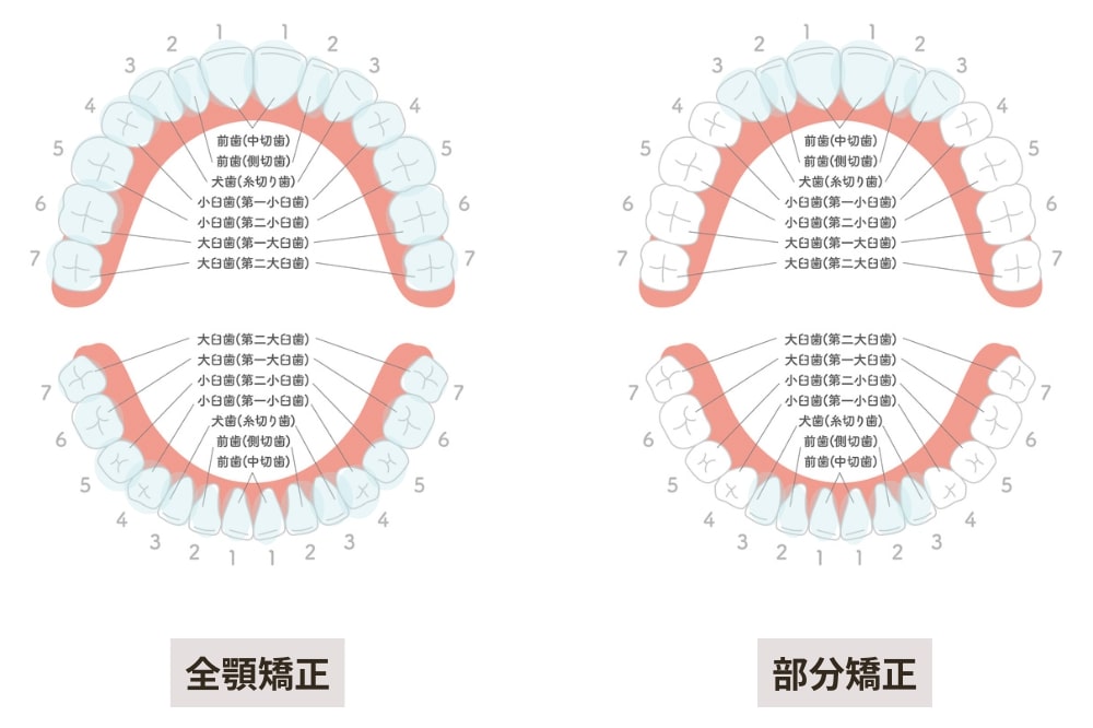 全顎矯正と部分矯正の治療範囲