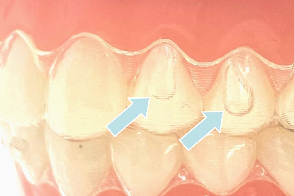 インビザラインのアタッチメント