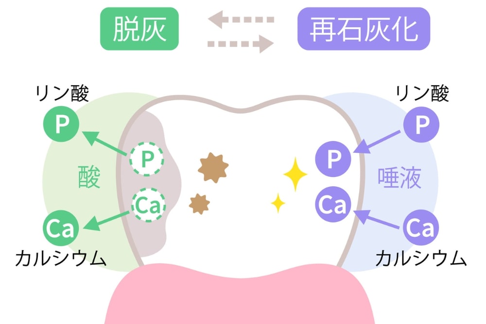 脱灰と再石灰化