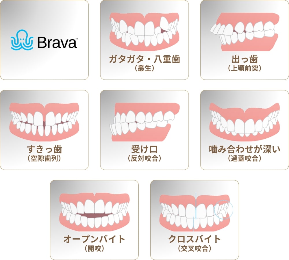 Brava矯正(ブラーバ矯正)で対応可能な歯並び