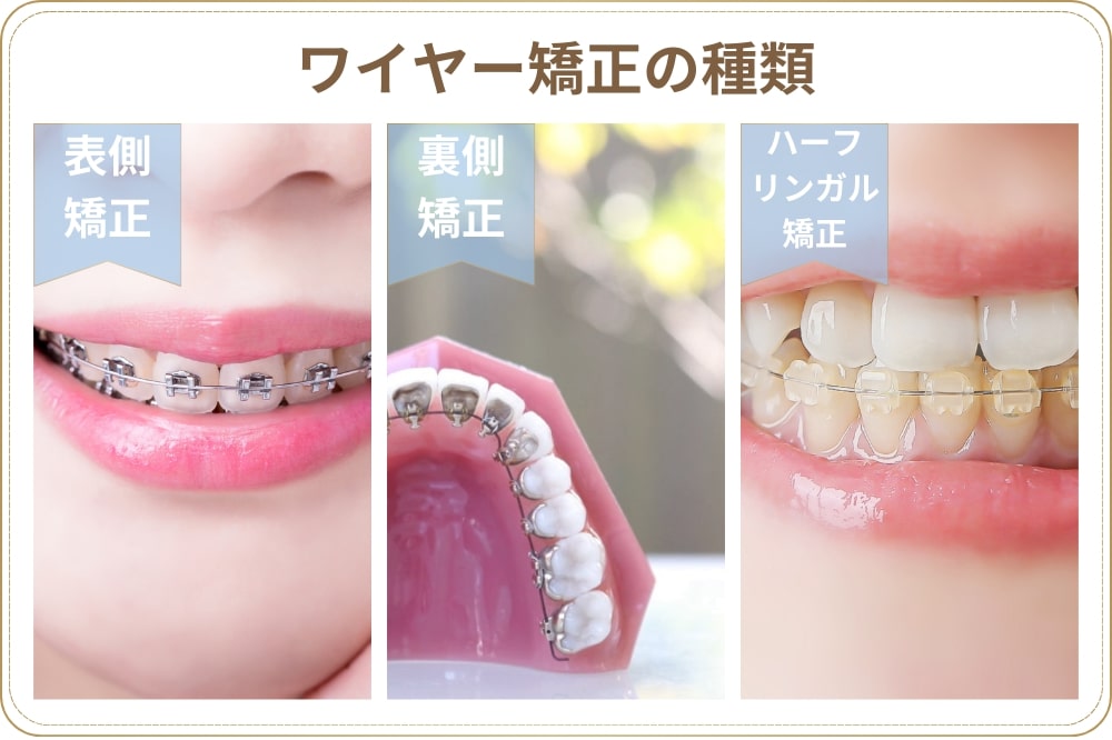 ワイヤー矯正の種類