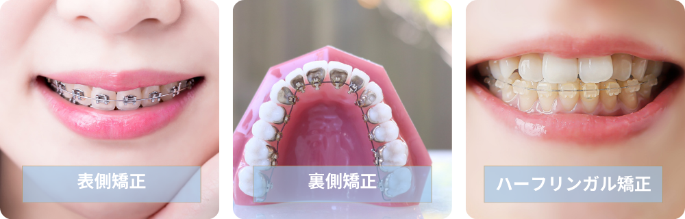 表側矯正・裏側矯正・ハーフリンガル矯正