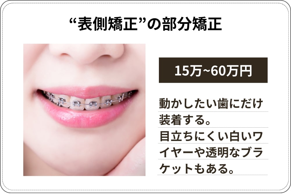 表側矯正（ワイヤー矯正）の部分矯正：費用相場15万円〜60万円