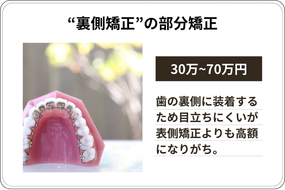 裏側矯正（舌側矯正・リンガル矯正）の部分矯正：費用相場30万円〜70万円