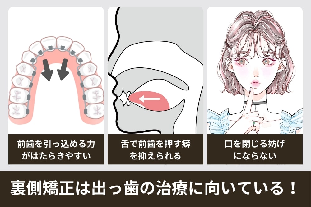 裏側矯正が出っ歯の治療に向いている理由