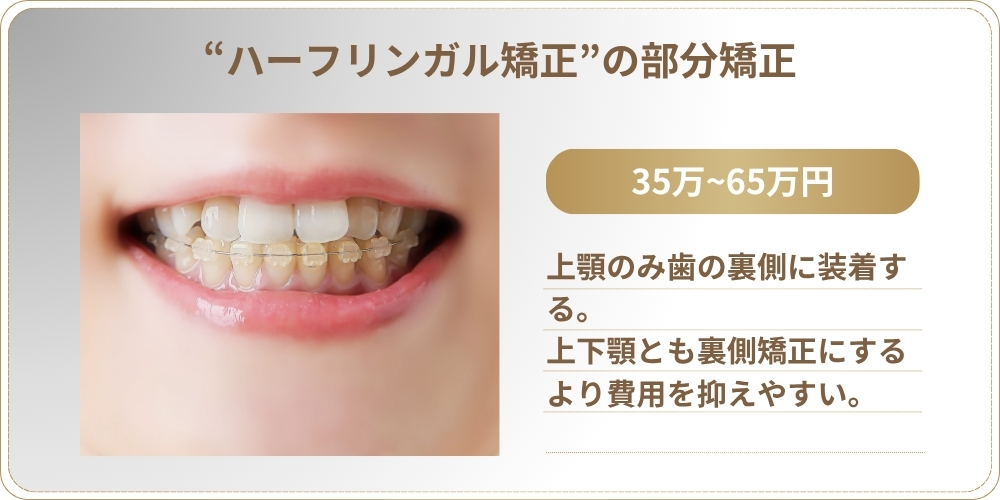 ハーフリンガル矯正の部分矯正：費用相場35万円〜65万円