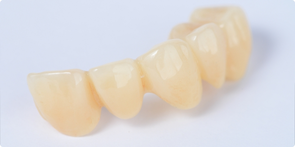 セラミック矯正