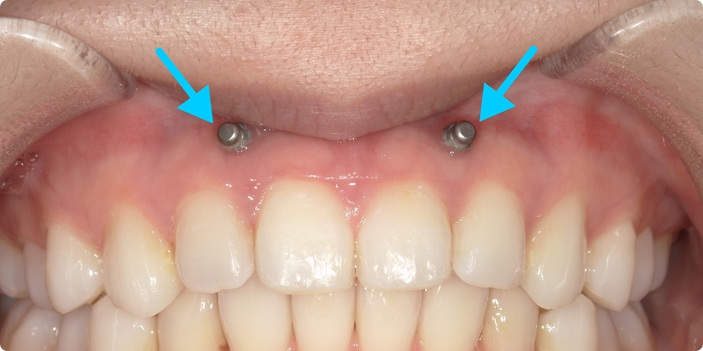 アンカースクリュー