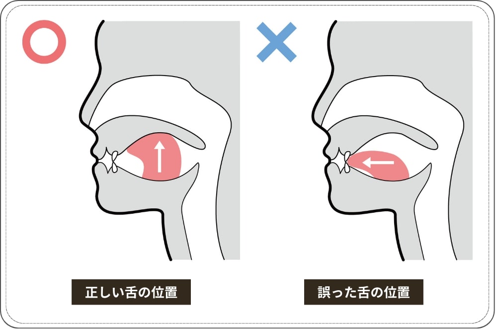 正しい舌の位置と誤った舌の位置