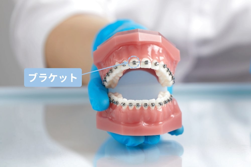 ワイヤー矯正の特徴