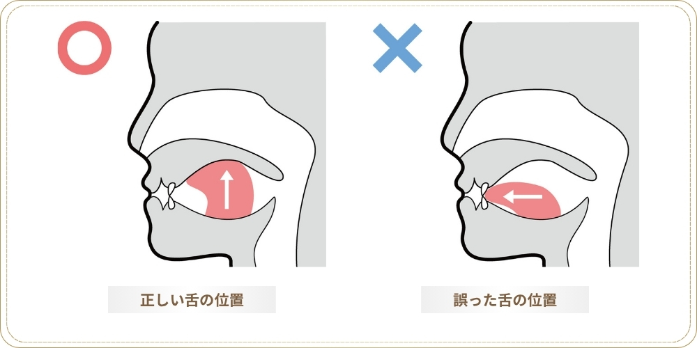 正しい舌の位置と誤った舌の位置