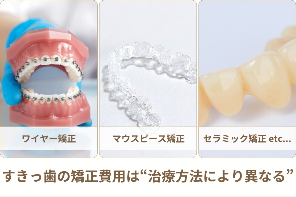 すきっ歯を矯正するなら目安費用はいくら？