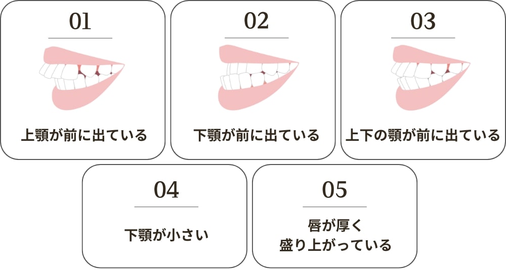 口ゴボの5つのタイプ