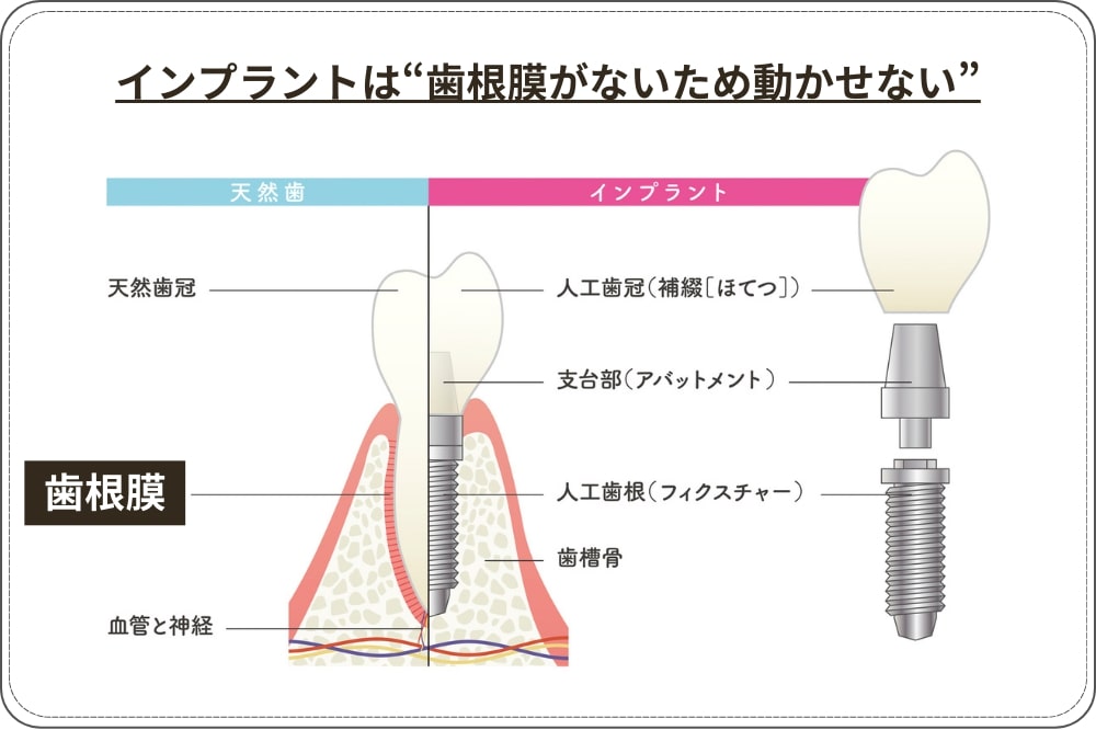 インプラントを複数入れている場合