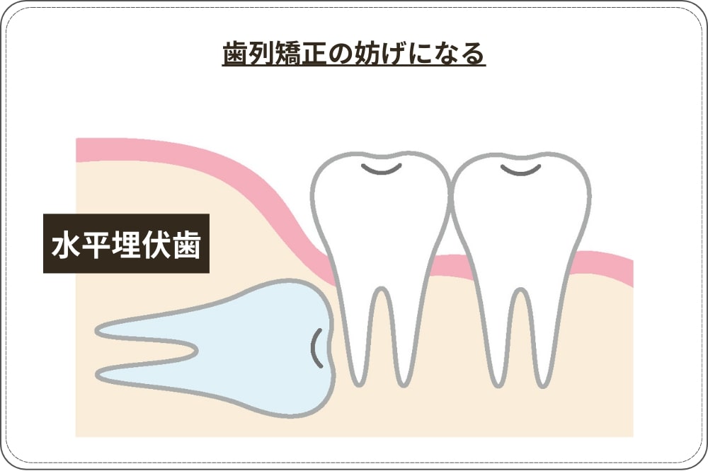 埋まっている歯（埋伏歯）がある場合