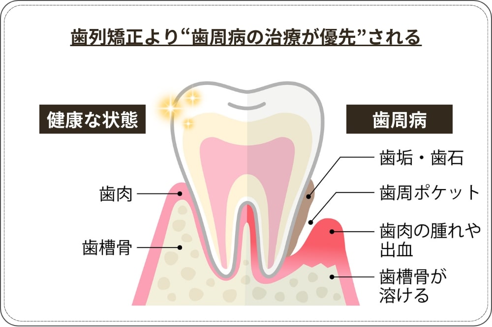 重度の歯周病がある場合