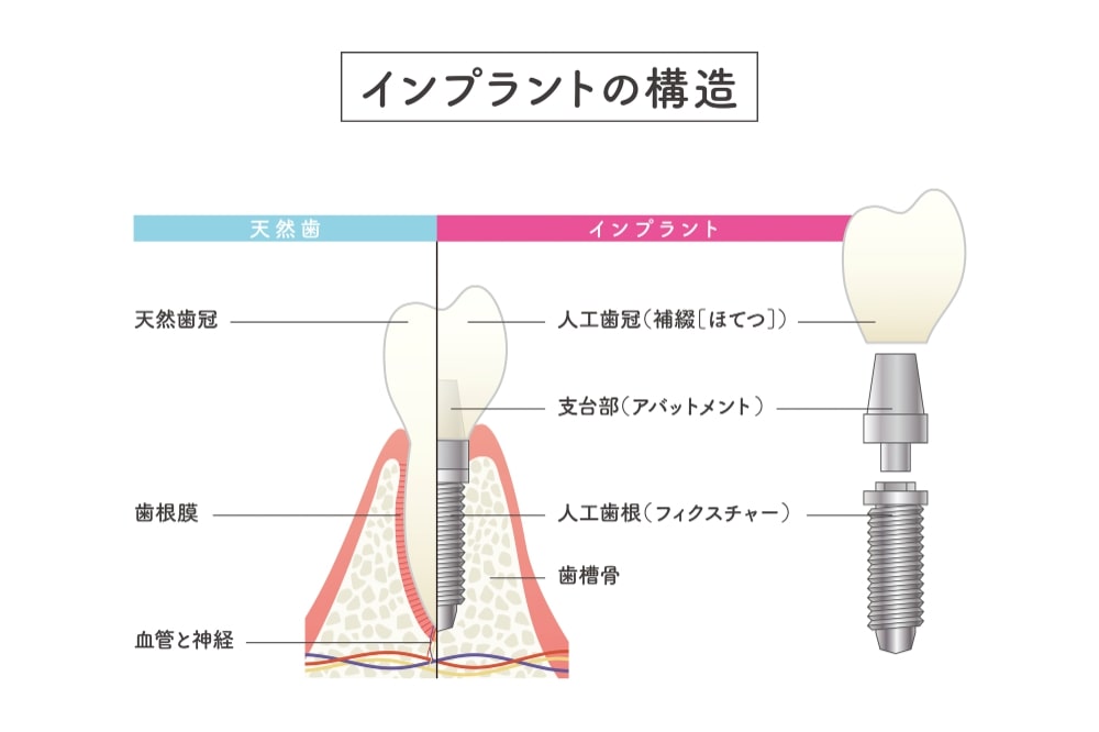 インプラントの構造