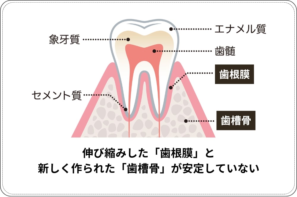 歯の矯正後に後戻りが起こる理由