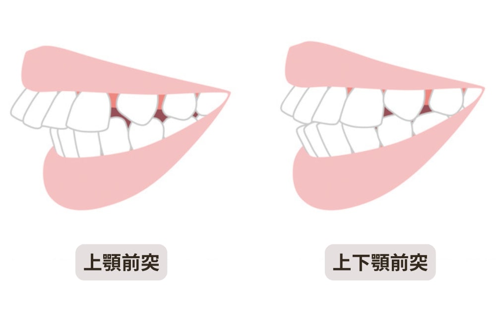 上顎前突と上下顎前突