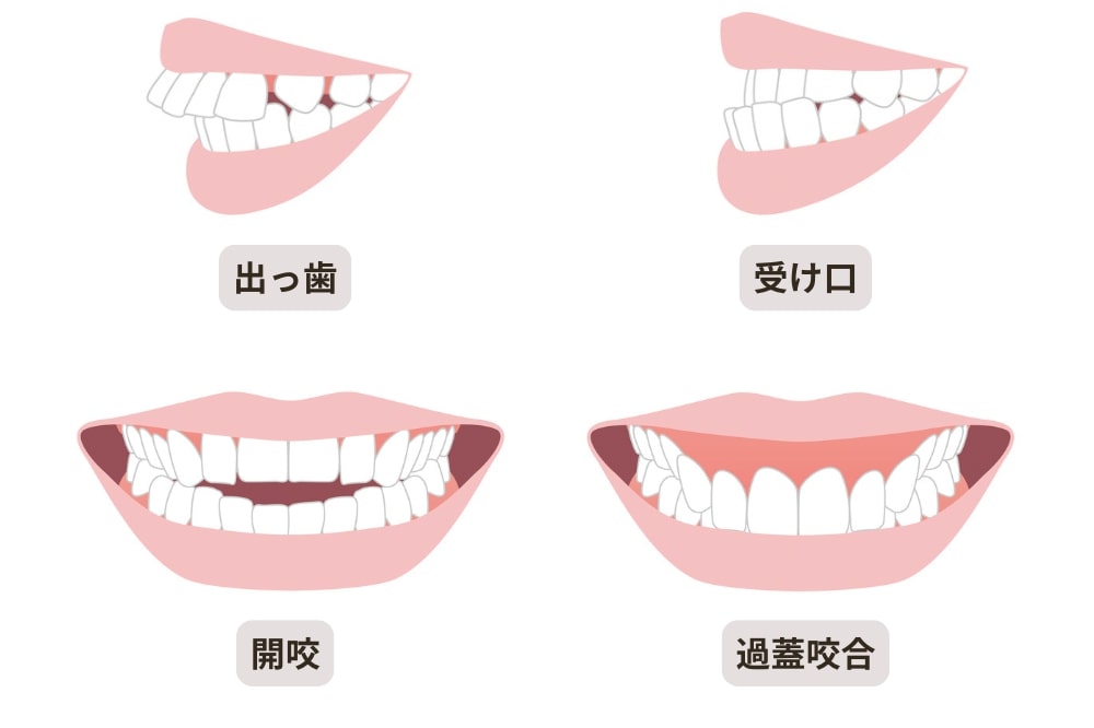 出っ歯・受け口・開咬・過蓋咬合