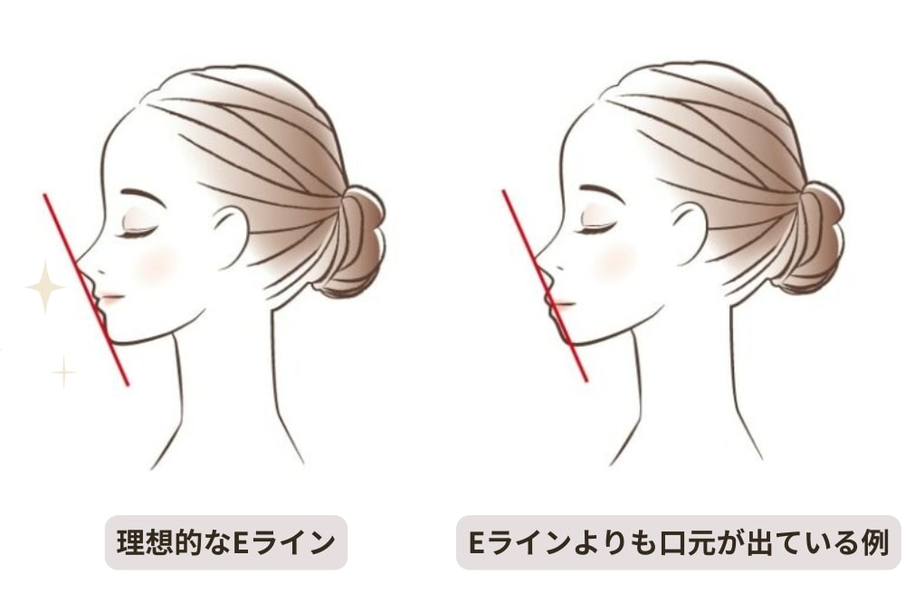 理想的なEラインと口ゴボ