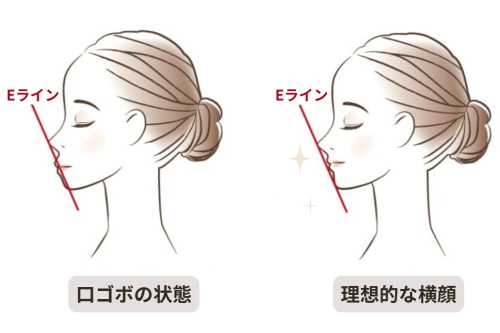 理想的な横顔と口ゴボの状態