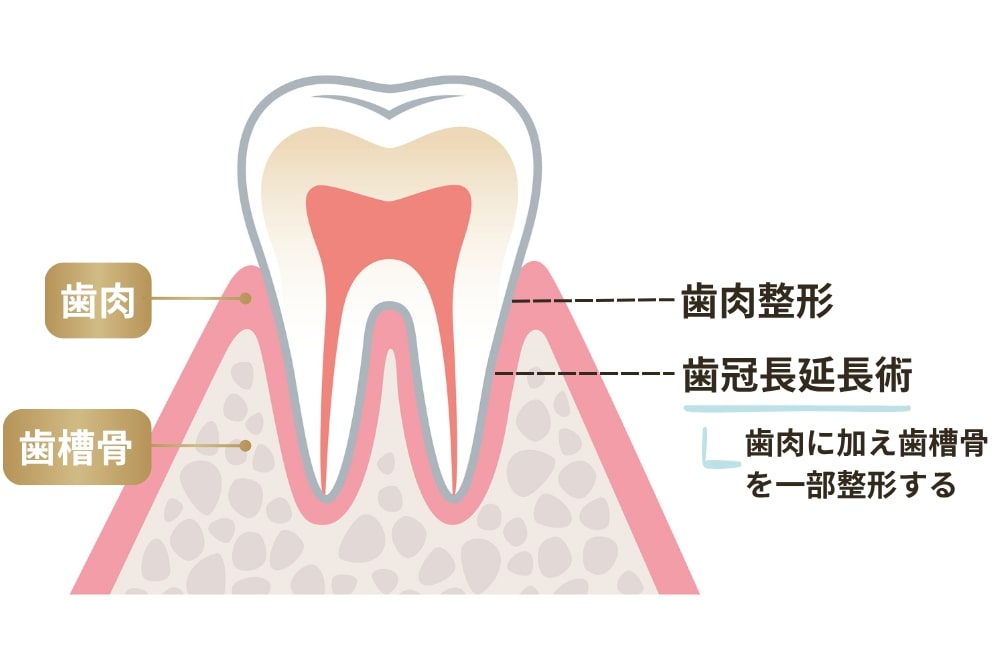 歯冠長延長術