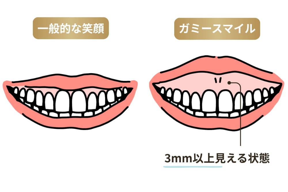 ガミースマイルとは歯茎が3mm以上見えている状態