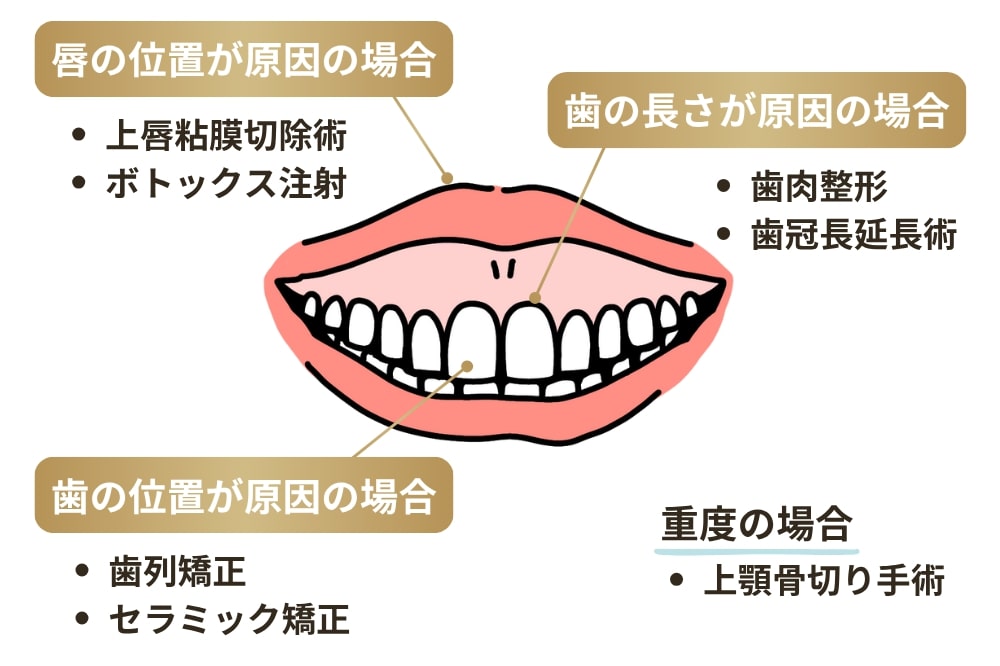 ガミースマイルの治療法｜主な7つのアプローチ