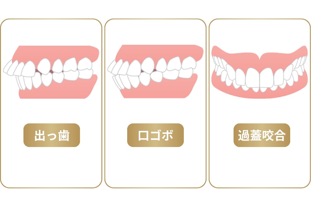 ガミースマイルの原因:骨格的な原因