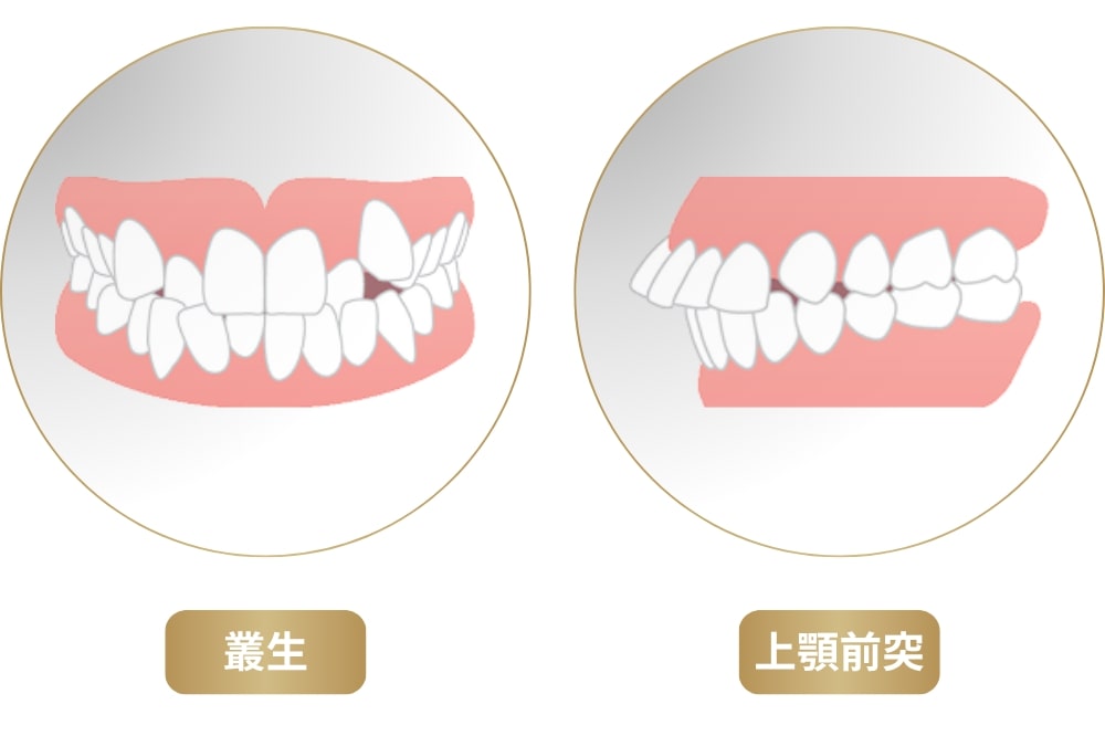 叢生(ガタガタな歯並び)と上顎前突(出っ歯)