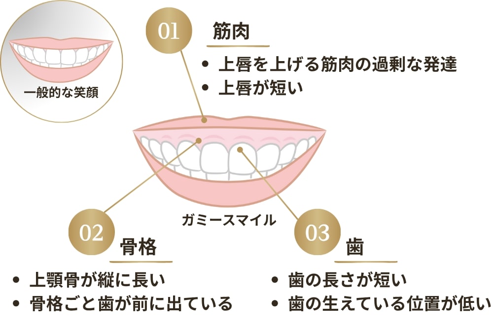 ガミースマイルになる原因