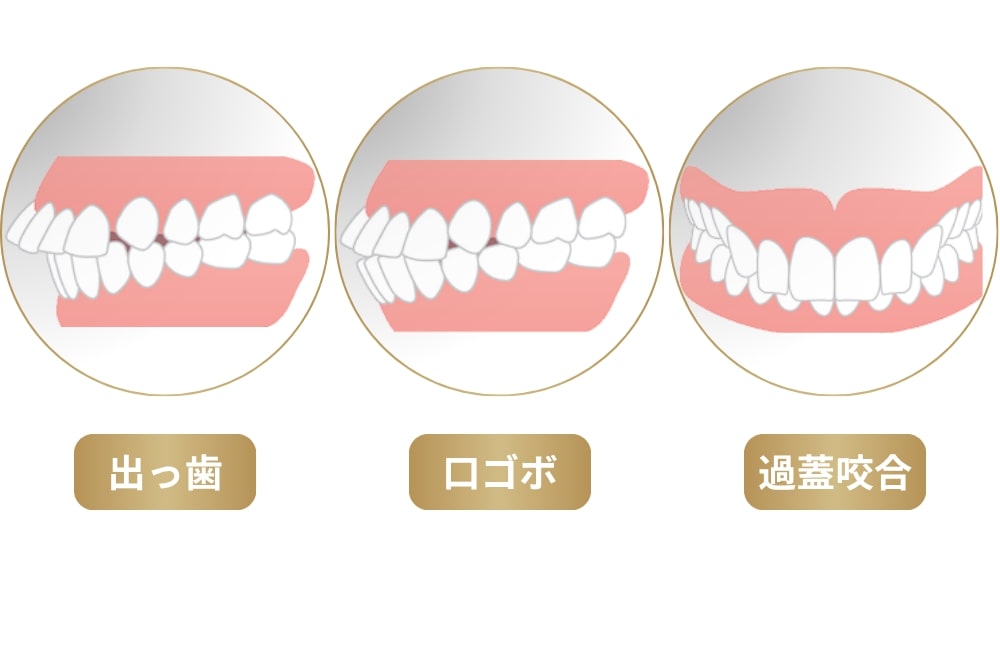 ガミースマイルになる原因：骨格ごと歯が前に出る歯並び