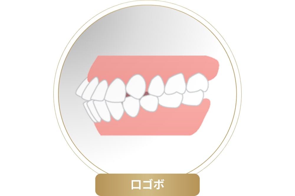 「口ゴボ」と呼ばれる口元突出の原因とは？