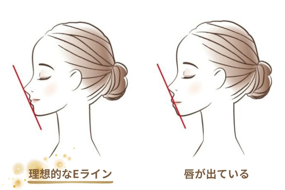 口ゴボか唇が厚いだけか、自分で見分ける方法はありますか？