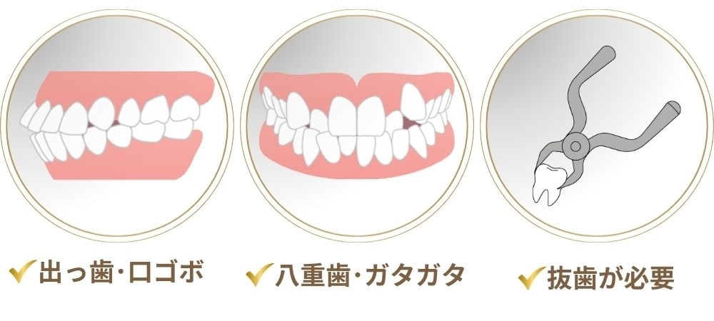 歯並びの変化で印象が変わりやすい人の特徴