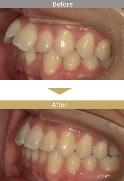 ブラーバ矯正で口ゴボ（出っ歯）を治した症例