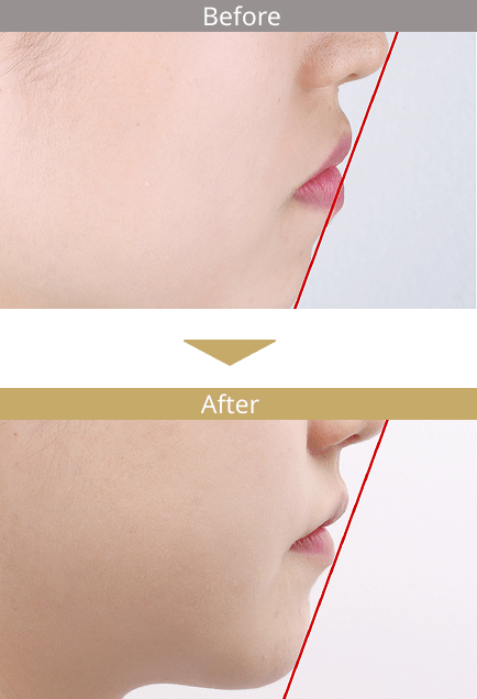 審美ワイヤー矯正で口ゴボを治した症例